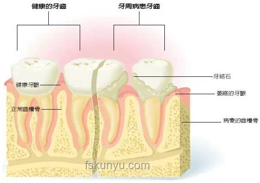 韦神牙周炎治疗：口腔健康新趋势预测